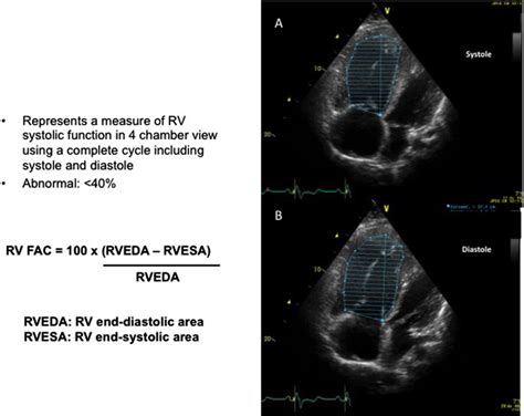 ultrasound fractional area change